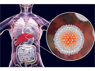 Steps Toward Eliminating Hepatitis C: Public Awareness and Early Diagnosis Are Key