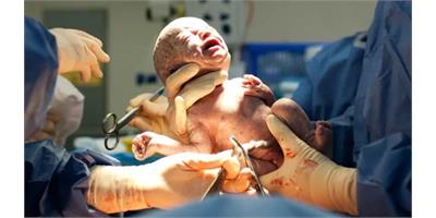 Unnecessary Cesarean Deliveries Threaten Mother and Baby’s Health