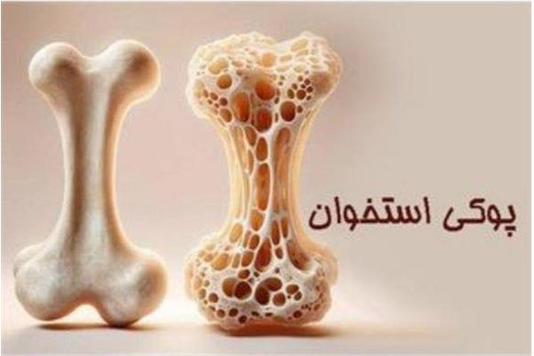 راههای مقابله با «پوکی استخوان» در هفته ملی سلامت استخوان